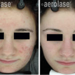NeoClear Acne - 3 Months After 5 Treatments - David Goldberg MD