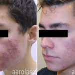 NeoClear Acne - After 4 Treatments - Kevin Pinski MD
