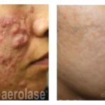 NeoClear Acne - After 5 Treatments - Michael Gold MD