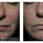 NeoSkin Rosacea and Veins - After 2 Treatments - David Goldberg MD